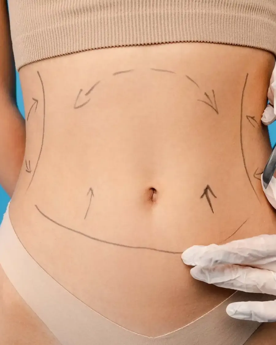 Liposuction at Cinch Clinics
